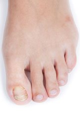 Nail Fungus Nail Fungus