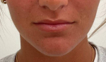 Juvederm® (Ultra XC) Case 1 Before
