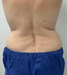 CoolSculpting® Case 2 Before