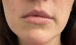 Juvederm® (Ultra XC) Case 3 Before