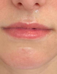 Juvederm® (Ultra Plus XC) Case 6 Before
