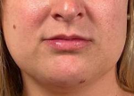 Juvederm® (Ultra XC) Case 4 Before