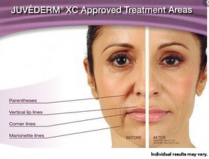 Juvederm