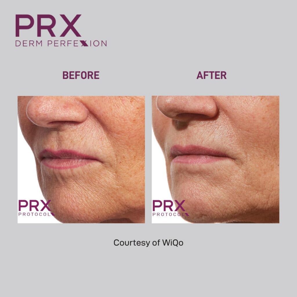 Before and after of PRX Derm Perfexion_